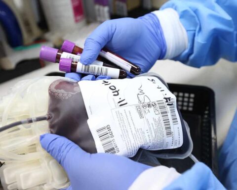 "Dies a quo" ed emotrasfusione con sangue infetto